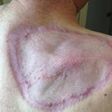 Both scc and bcc may be without symptoms, or grow slowly over time with. Approach To Management Of Giant Basal Cell Carcinomas Mdedge Dermatology
