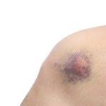 24 yo he/him esp/eng ◉ commissions open! Bluterguss Und Einblutung Im Kniegelenk Richtig Behandeln