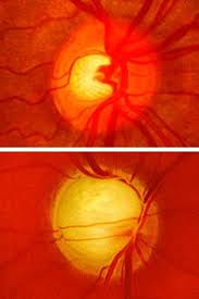 Primary care physicians can play an important role in the diagnosis of glaucoma by referring patients with positive family history or with suspicious optic nerve head findings for complete ophthalmologic examination. High Eye Pressure Monitor Or Treat The Source Washington University In St Louis