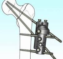 A pertrochanteric fracture fixed with the Orthofix ...