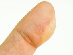 Burn Blister: First Aid, Treatment, And Types Of Burns