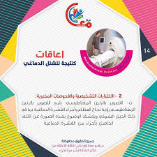 pin pa حقائق عن متلازمة داون