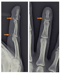 This creates a tug of war, where the. 55 Year Old Woman With Injury To Her Right Finger Page 2 Of 2 Journal Of Urgent Care Medicine