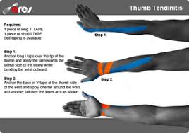 Vendaje Neuromuscular Y Tendinitis De Quervain Vendaje Neuromuscular Terapia De La Mano Tendinitis