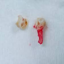 乳歯 根っこ 残る