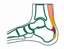 Haglund Exostose Ogam Orthopadie