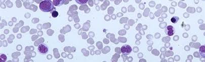 É uma doença dos glóbulos brancos (leucócitos), e muitas vezes, sua origem é desconhecida. Que Es La Leucemia Todos Sus Tipos Infosalus Com
