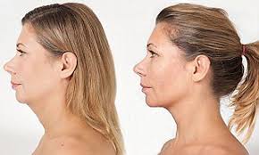One Stitch Facelift Quick Fix Plastic Surgery For Turkey Neck Daily Mail Online