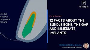 Here, you'll find a unique set of resources, including education, practice support, advocacy and protection. 12 Facts About The Bundle Bone The Gap A Nd Immediate Implants Periospot
