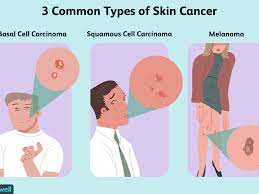 If cancer cells are seen, another layer of skin is removed and checked, and the process continues until the skin layer shows no signs of cancer. How Skin Cancer Is Treated