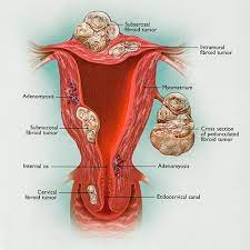 They may be related to high oestrogen levels; Uterine Fibroids The Center For Innovative Gyn Care