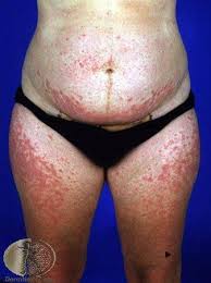 Image result for pruritic urticarial papules and plaques of pregnancy