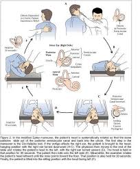 Benign positional vertigo is also called benign paroxysmal positional. Epley Maneuver Physical Therapy Vertigo Treatment Vertigo