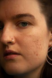 Wenn du dichtes haar hast und einen pony à la caroline de maigret trägst, könnte es ebenfalls sein, dass sich auf deiner stirn kleine pickel bilden. Hormonelle Akne Welche Behandlung Hilft Wirklich