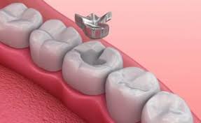 A typical filling procedure only takes about an hour. How Your Dentist Uses Dental Fillings To Stop Tooth Decay