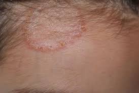 Cara merawat tanaman cabe di usia 0 haring hingga 1 bulan 2. Cara Alami Mengobati Penyakit Kurap Pada Kulit Anda Bisa Mencobanya Di Rumah Jurnal Palopo