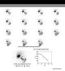 Cholescintigraphy Radiology Reference Article Radiopaedia Org