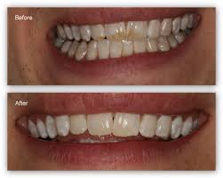 By removing plaque daily you are keeping your teeth & gums healthy. Tooth Stains Gallery Dr Jack M Hosner D D S