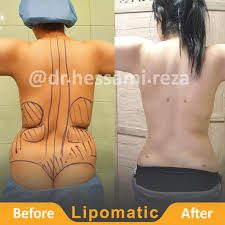 Liposuction Abdominal Fat And Rib Fat Injection In The Buttocks In Iran Dr Reza Hessami Irantreatments
