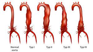 Abdominal Aortic Disease Maryland Vascular Specialists