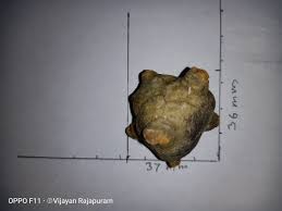 Other risk factors for developing bladder cancer include older age, male gender, exposure to toxic bladder cancer may not initially cause signs or symptoms. Bladder Stone Wikipedia