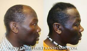 Hair Transplant Recommended Clinics in Massachusetts Berkshire East Lee