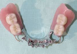 They tend not to look as realistic as other types of dentures, but they can be useful when a denture is needed in a hurry, or when a patient is being fitted with an immediate denture. Partial Dentures Plates