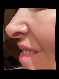 Please help me choose revision rhino 1.Doc Porquez 2.Doc Alfred Dizon 3.Doc  pareja