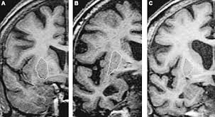 Lewy body dementia (lbd) is a type of progressive dementia. Atrophy Of The Putamen In Dementia With Lewy Bodies But Not Alzheimer S Disease Neurology