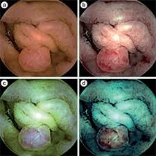 Image result for Virtual Endoscopy