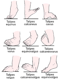 Most clubfeet can be successfully corrected using the nonsurgical ponseti method. Talipes Definition Of Talipes By Medical Dictionary