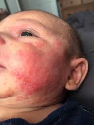 Image result for yellow scabs on the face in children