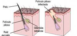 Forunculo Archivos Clinica Proctologica