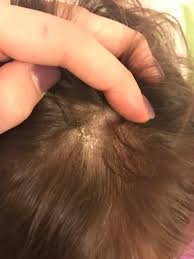 Image result for dry scabs on the head in children