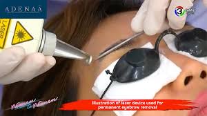 eyebrow tattoo removal with laser
