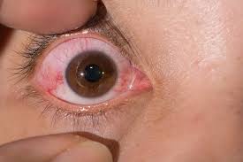 Image result for Scleritis