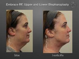 Maybe you would like to learn more about one of these? Embrace Rf New Orleans Center For Aesthetics Plastic Surgery