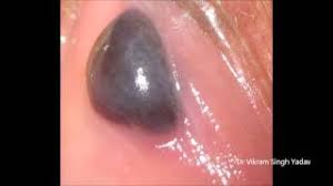 Check spelling or type a new query. Does Your Mouth Appear Like This Blood Sores Tinyleaflondon Com