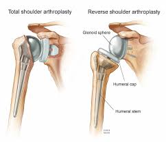 Global Reverse Shoulder Arthroplasty Market To Grow At A Cagr Of 12 14 To 2020 Physical Therapy Shoulder Shoulder Surgery Shoulder
