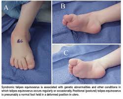 Of the 39 patients who had at least one relapse, 13 required further casting and a tibialis anterior tendon. Current Concepts With The Ponseti Technique