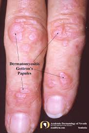 Image result for Dermatomyositis