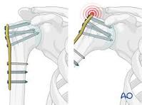 ORIF - Plate fixation for Extraarticular 2-part, surgical ...