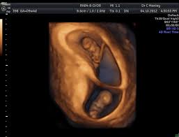 12 week pregnancy dating scan: Launceston Obstetrics And Gynaecology Ultrasound