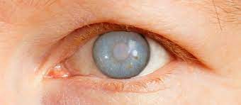 Glokom Goz Tansiyonu Levent Optik