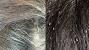 Scalp Fungus Dandruff In Kids