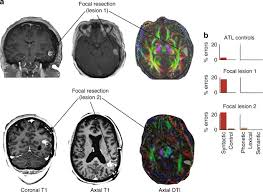 They can be delegated free morphemes, which can remain solitary as words, or bound morphemes, which should be joined with another morpheme to shape a total word. Neural Encoding And Production Of Functional Morphemes In The Posterior Temporal Lobe Nature Communications