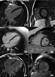 Image result for Cardiac MRI