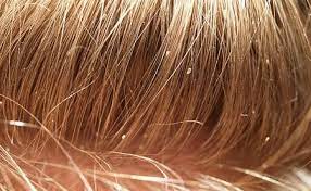 Some people use them together. Can Fleas Live In Human Hair Pestseek