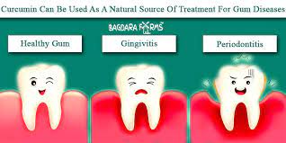 The most common cause of gingivitis is poor oral hygiene that encourages plaque to form on teeth, causing inflammation of the surrounding gum tissues. Get Rid Of Gingivitis With Curcumin