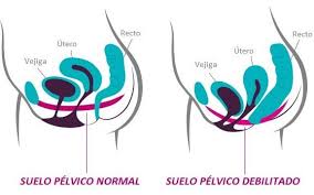 SUELO PÉLVICO: normal, hipertonico o debilitado? Como vemos en la imagen, el suelo pélvico, con esa forma característica de hamaca, es el punto de apoyo de la vejiga, el útero (y la